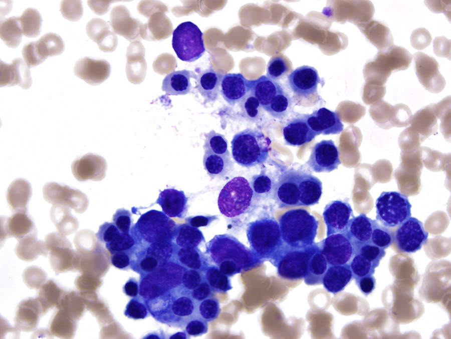 Fig 1D BMA 100x dysplastic erythropoiesis